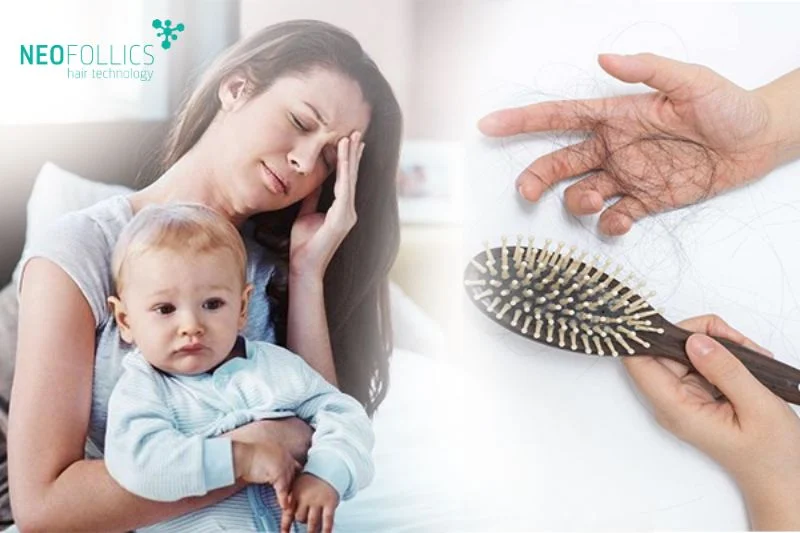Rụng tóc sau sinh làm các mẹ bỉm có thể rụng đến 100 sợi tóc mỗi ngày