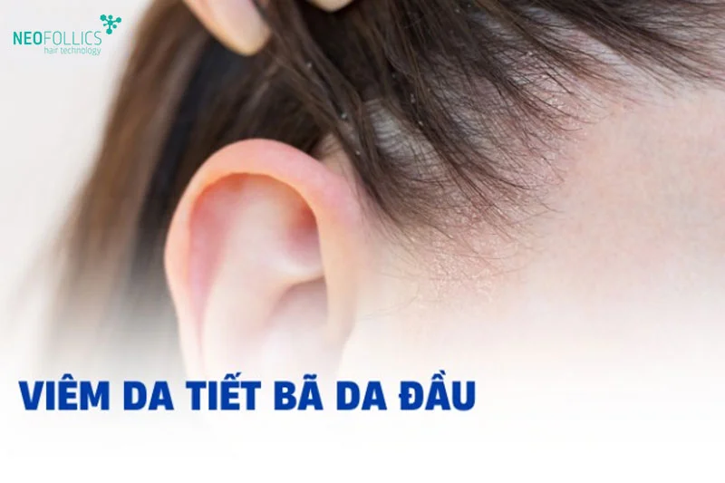 Viêm da tiết bã da đầu là bệnh có diễn biến dai dẳng, khó điều trị và hay tái phát