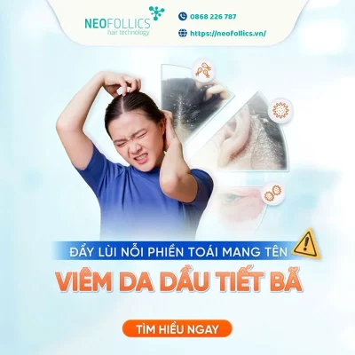Viêm da tiết bã da đầu là bệnh có diễn biến dai dẳng, khó điều trị và hay tái phát