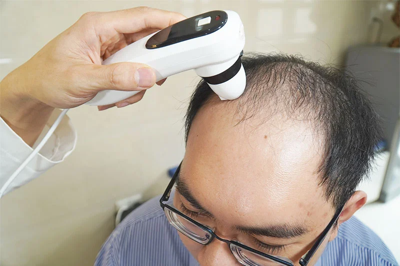 Sức khỏe da đầu đóng vai trò quan trọng trong sự phát triển của nang tóc